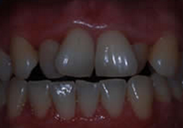 invisalign braces