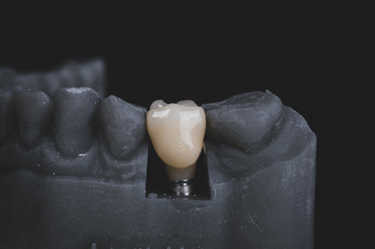 Dental implants model in Pontefract