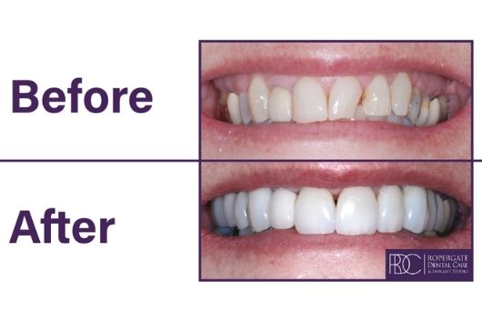 Dental Implants Before & After | Ropergate Dental Practice Pontefract