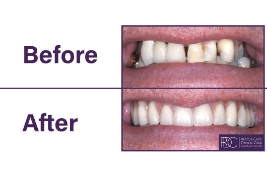 Dental Implants Before & After | Ropergate Dental Practice Pontefract