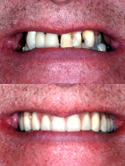 Dental implants before and after in Pontefract