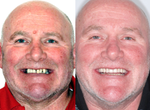 Dental implants before and after in Pontefract