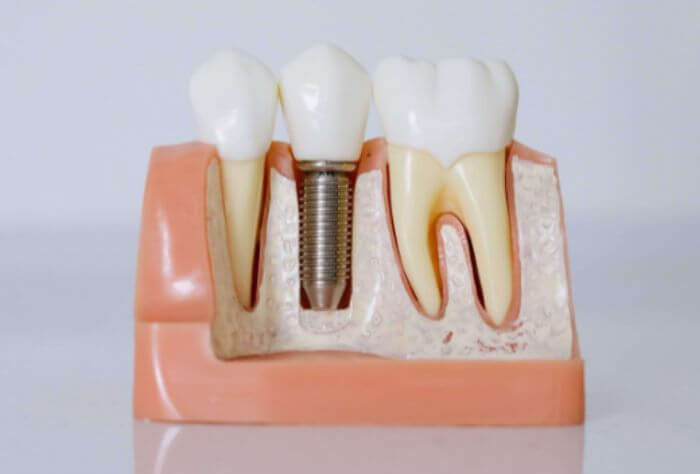 dental implants model
