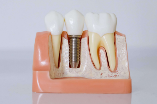 Dental Implants| Ropergate Dental Practice Pontefract
