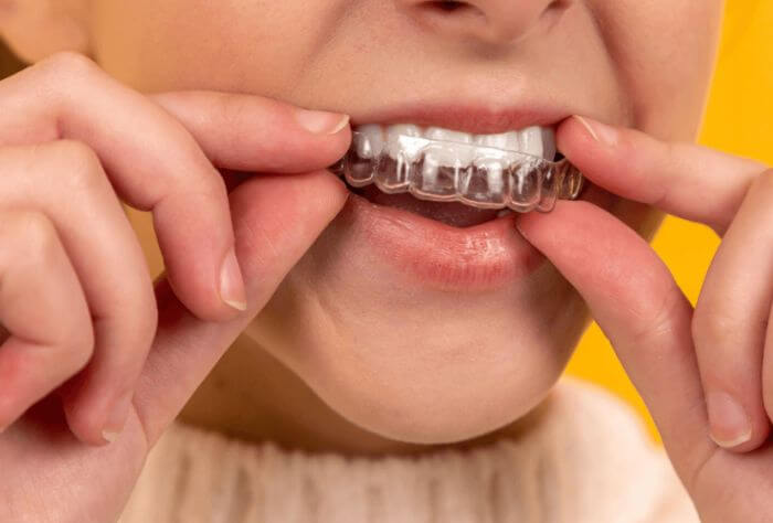 putting invisalign aligners on teeth