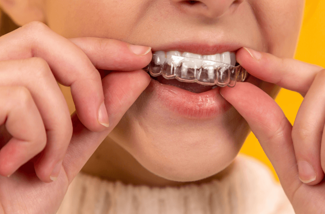 Invisalign Clear Braces | Ropergate Dental Practice Pontefract