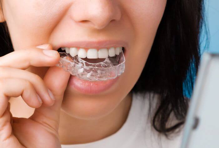 Woman holding invisalign aligners to her mouth