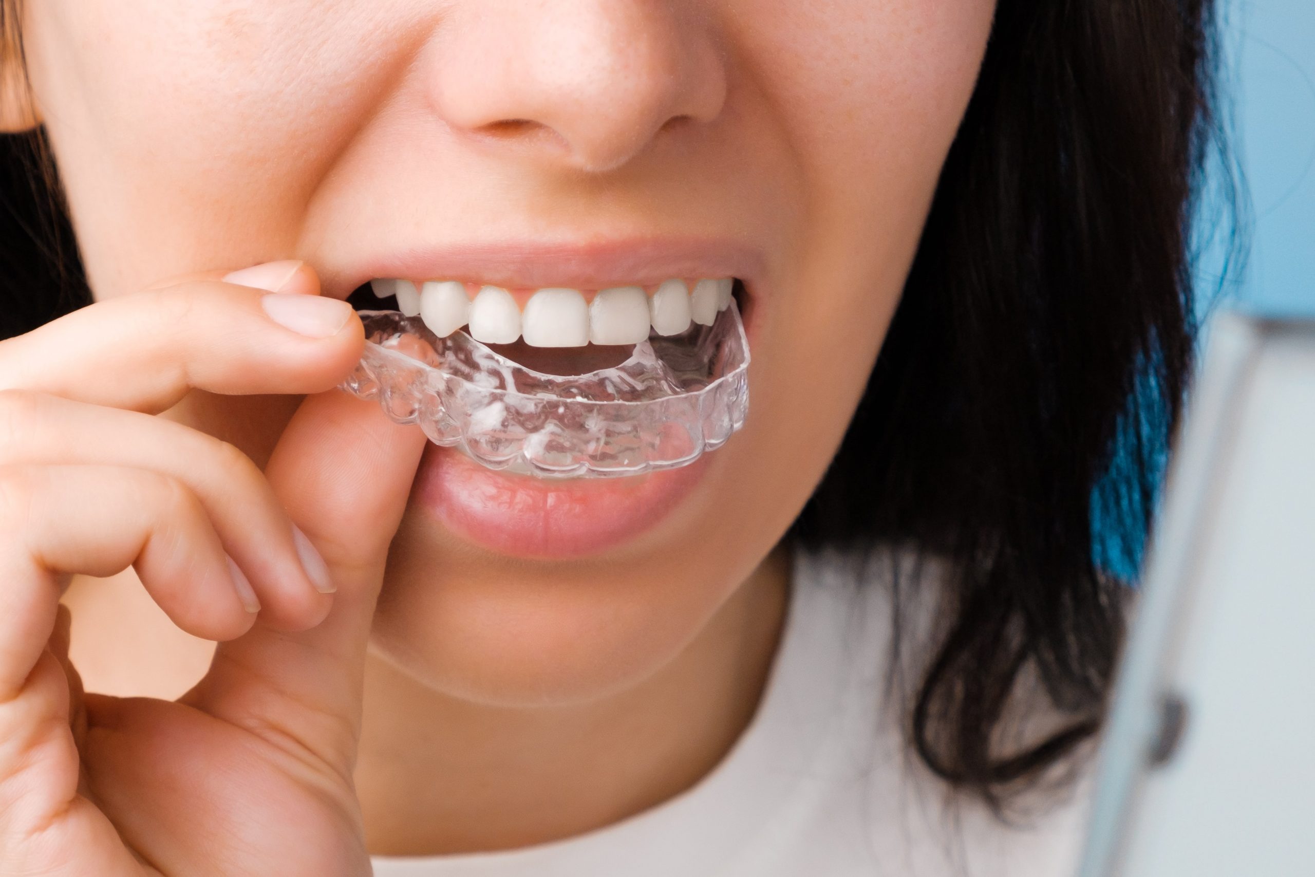 Invisalign Clear Braces | Ropergate Dental Practice Pontefract