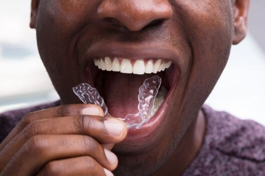 Man putting in Invisalign aligners in Pontefract