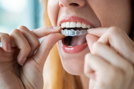 Woman putting in Invisalign braces in Pontefract - Invisalign do's and dont's
