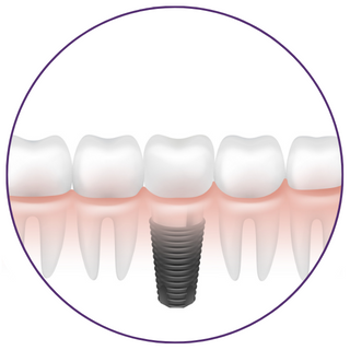 dental implants in Pontefract