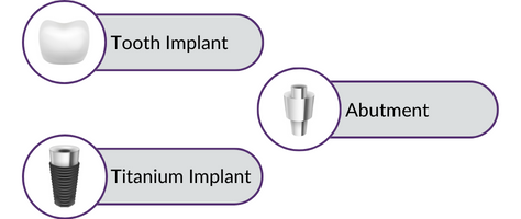 Dental implant diagram in Pontefract