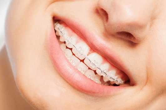 lady smiling with braces after getting them installed at ropergate dental