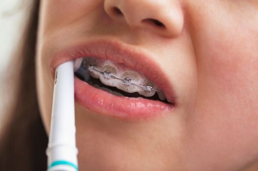 Girl brushing her teeth with braces in