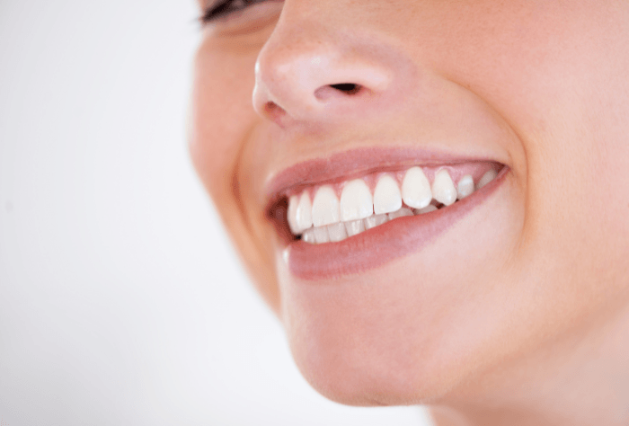 Woman smiling after composite bonding